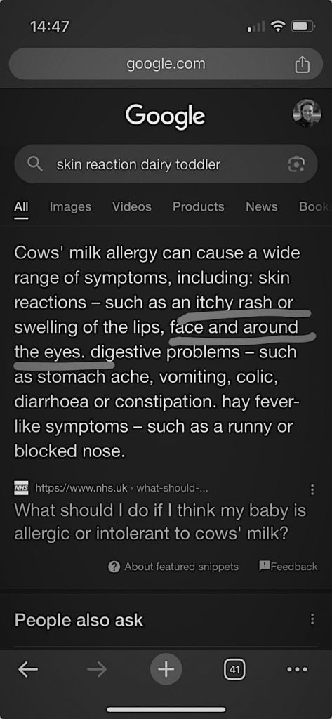 Milk allergy symptoms in babies