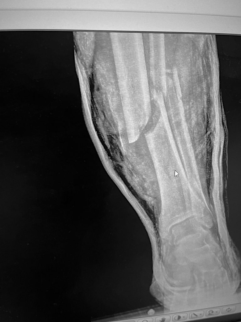 Broken Febula & Tibia A