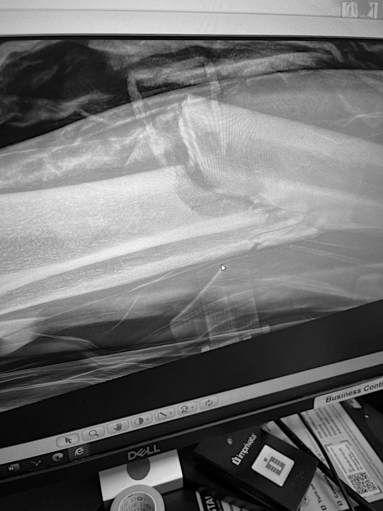 Broken Febula & Tibia B