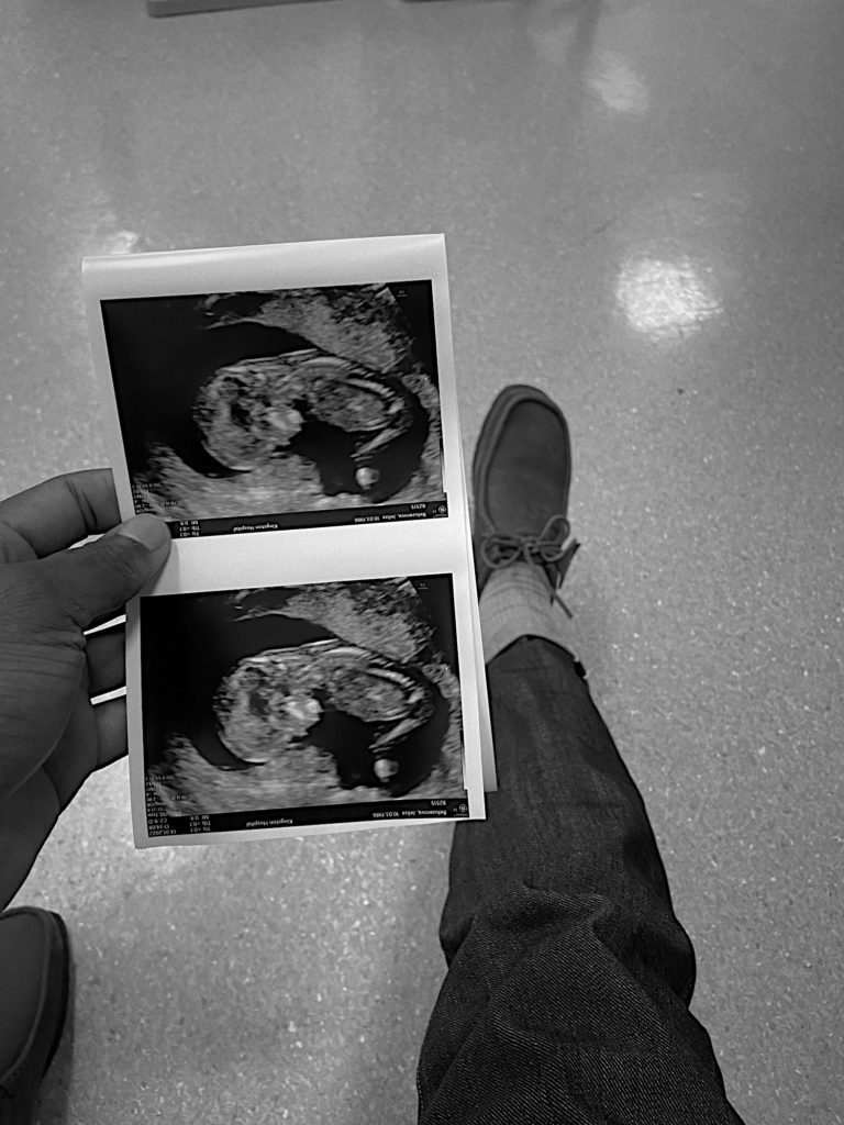 12 week scan